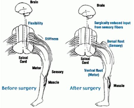 SDR műtét előtt és után